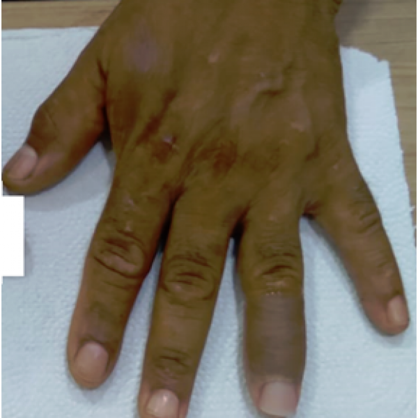 PROTESE ESTÉTICA DE SILICONE